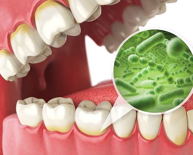 Animated smile with closeup of bacteria at gum line