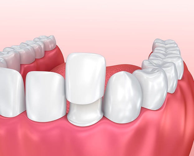 Animated all ceramic dental crown placement