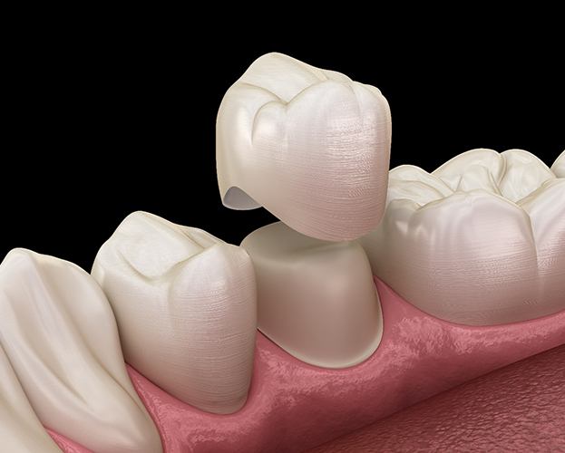 closeup diagram of a dental crown