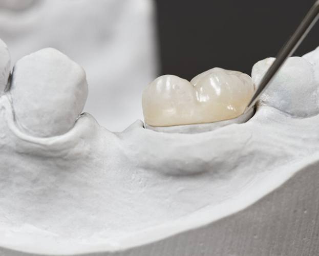 closeup of a model of a dental crown within a model of the patient’s teeth