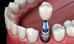 diagram of dental implant for one tooth in Williamsville