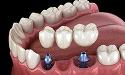 diagram of dental implants for multiple missing teeth in Williamsville 