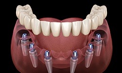diagram of implant denture in Williamsville for missing all teeth