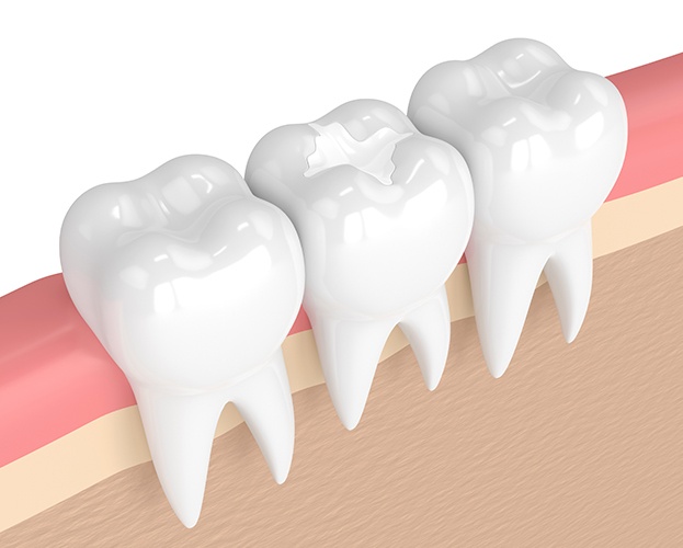 Animated teeth with dental sealants