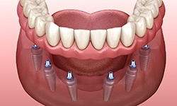 diagram showing implant dentures in Williamsville