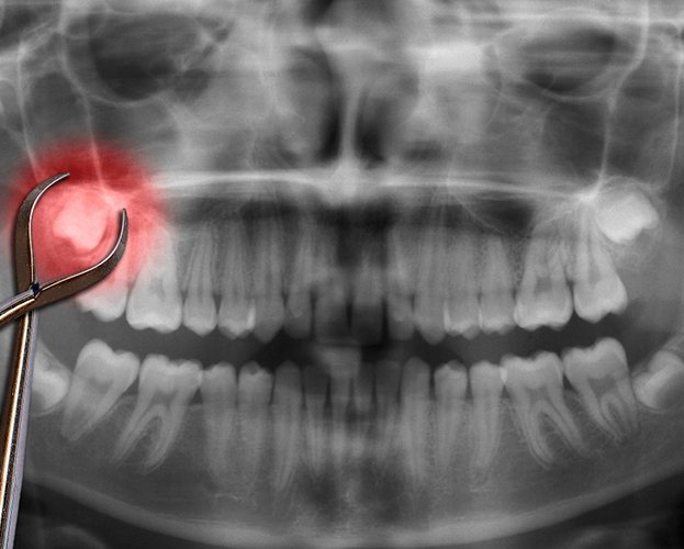 X-ray of teeth that need to be extracted