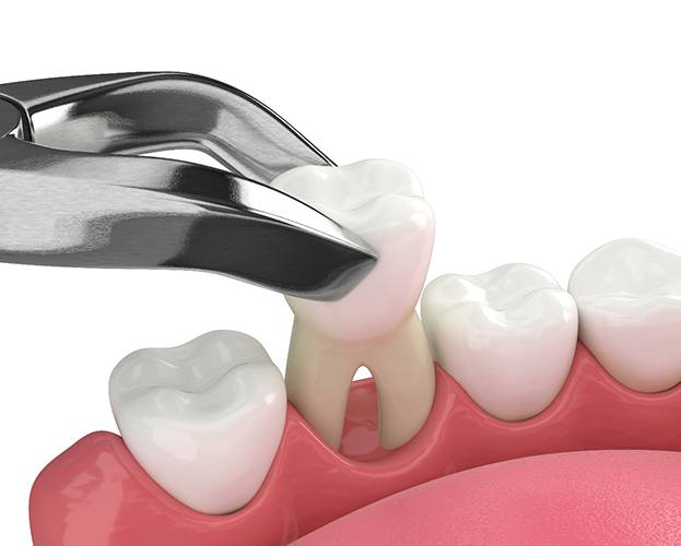diagram of a tooth being extracted
