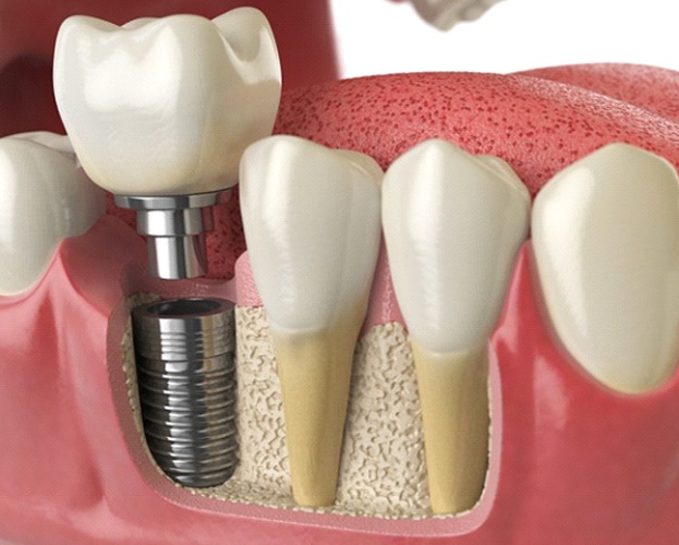 diagram of a dental implant in Williamsville