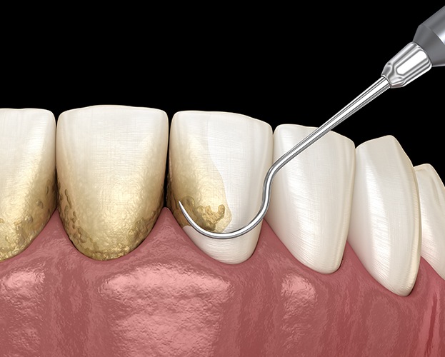 Animated scaling and root planing periodontal therapy