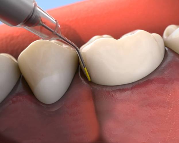 Animated smile during arestin antibiotic therapy