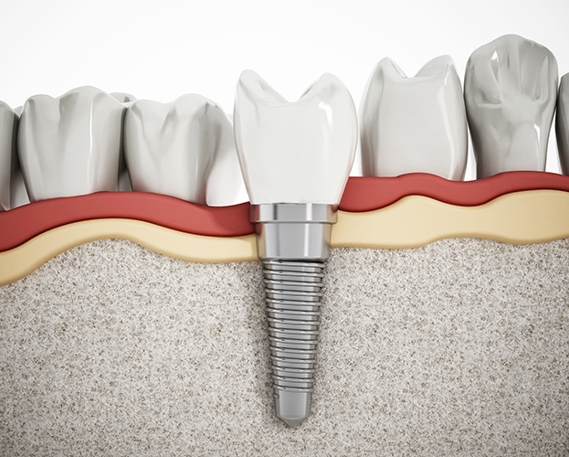 Animated dental implant supported replacement tooth