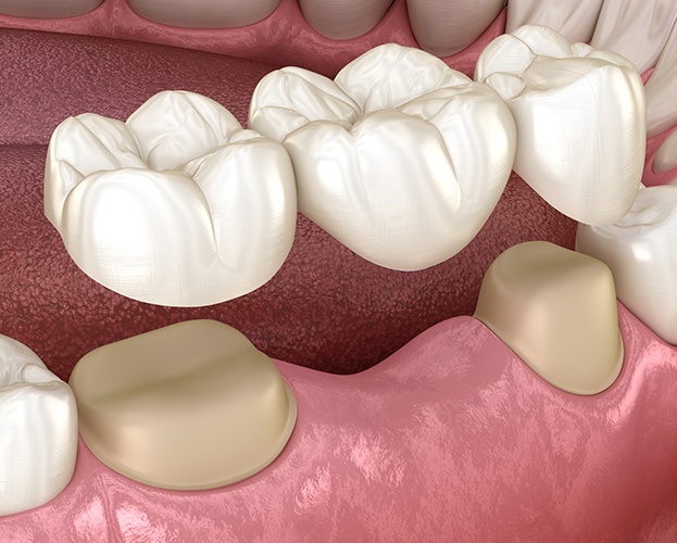 Animated dental bridge placement