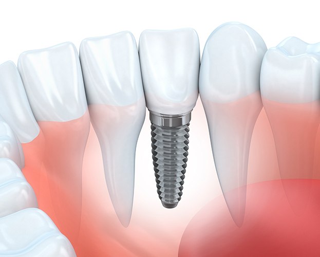 Animated dental implant supported dental crown