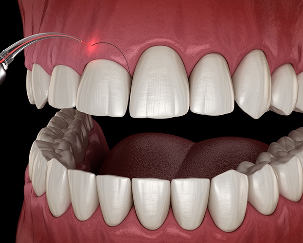 Animated smile after gum recontouring