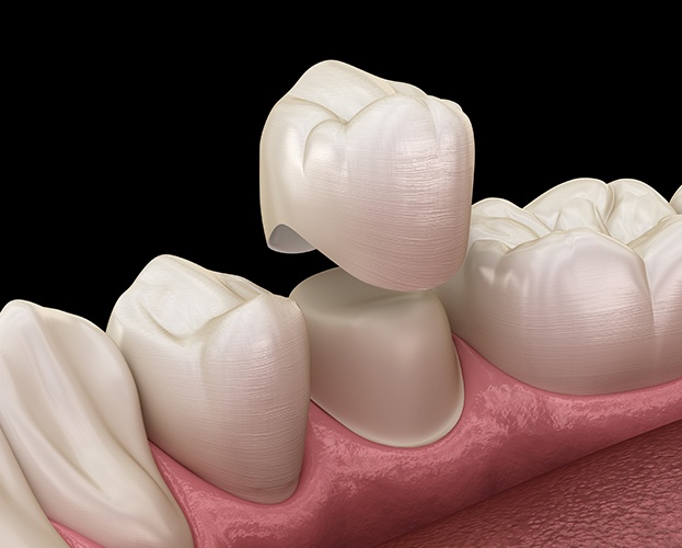 Animated dental crown placement