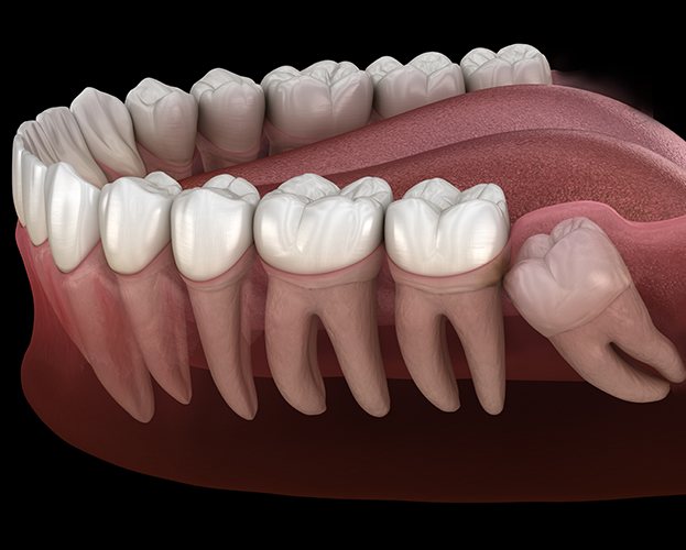 Animated smile with impacted wisdom tooth