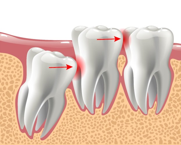 X-ray of smile with impacted wisdom tooth