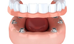 the parts of your dental implant