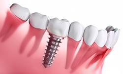 Affordable dental implant