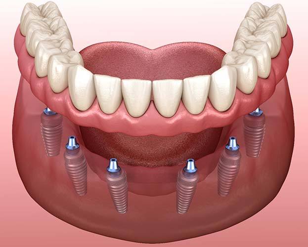 diagram of implant dentures in Williamsville