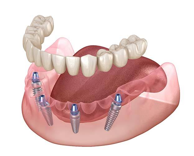 diagram of four dental implants in Williamsville holding dentures