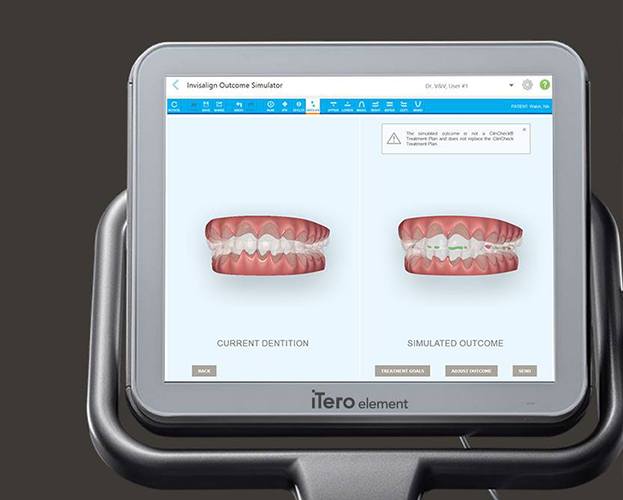 iTero Invisalign clear braces treatment plan