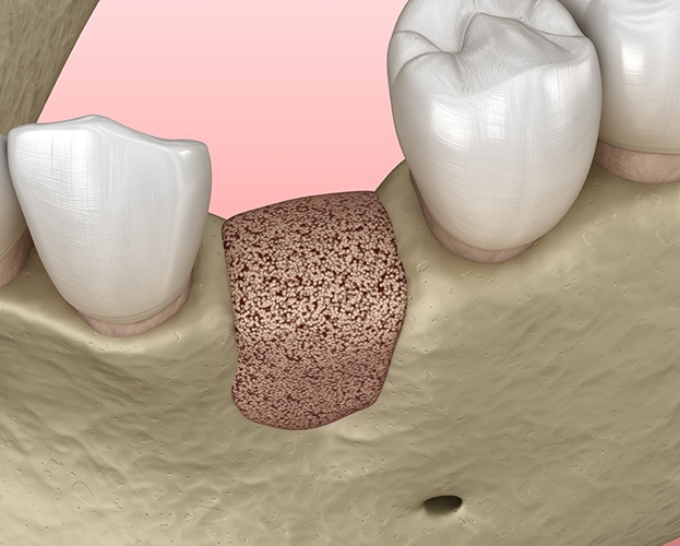 Animated bone graft for socket preservation