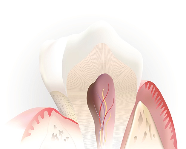 Animated tooth before root canal therapy