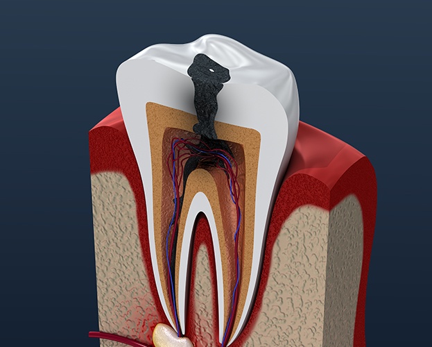 Animated tooth in need of root canal therapy