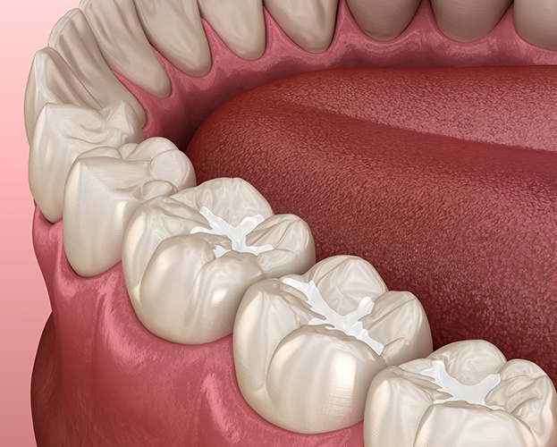 Animated smile with tooth colored fillings