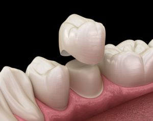 diagram of a dental crown going over a tooth